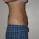 2 months after smart lipo - side